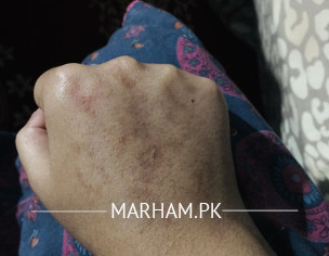 Skin Issue