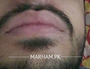 Nose Problem ENT