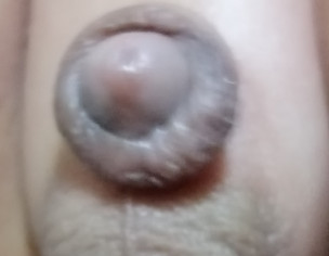 Circumcision