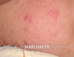 Skin Problem