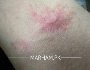 Psoriasis Skin 