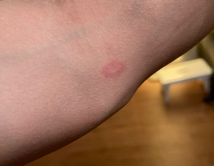Skin Red Bumps