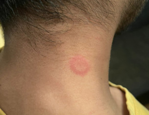 Skin Red Bumps