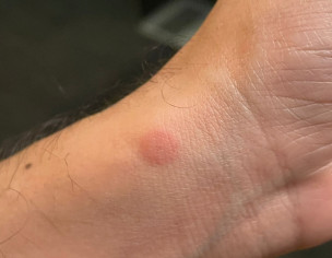 Skin Red Bumps
