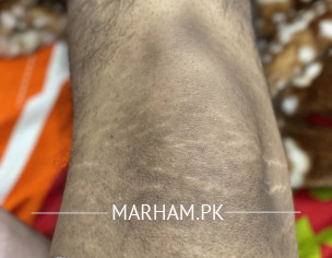 Dark Knees
