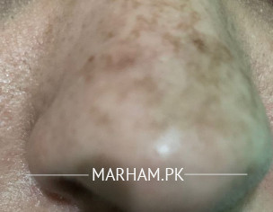 Face Dark Circles
