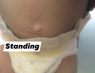 Umbilical Hernia
