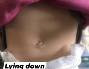 Umbilical Hernia
