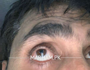 Redness In Eyes 