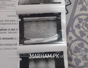 Varicocele Problem