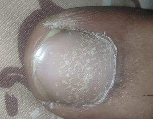 Nail Scaling