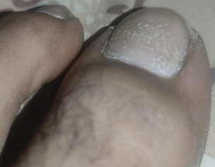 Nail Scaling
