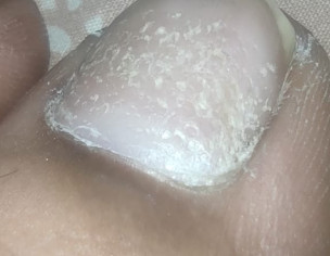 Nail Scaling