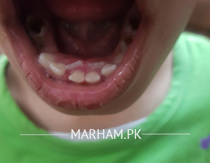 Double Teeth
