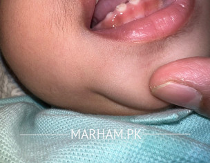 White Spots On Teeth