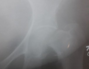 Hip Fracture 