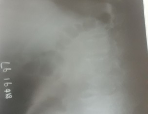 Hip Fracture 