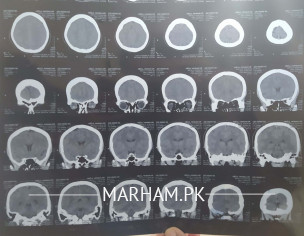CT Scan Plane Brain