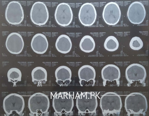 CT Scan Plane Brain