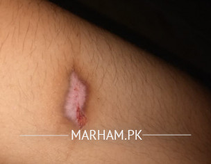 Burnt From Iron