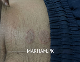 Skin Problem