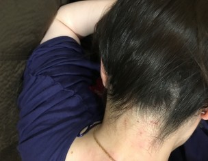 Head Itching/rash