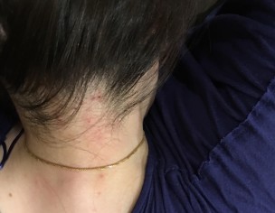Head Itching/rash