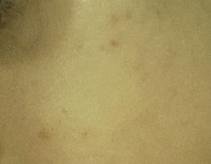 Light Mild Red Spots Acne