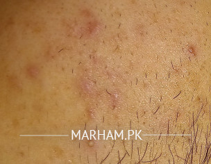 Acne Problem