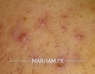 Acne Problem