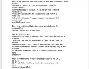 Parkinson Plus