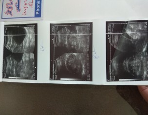 Weak Kidneys