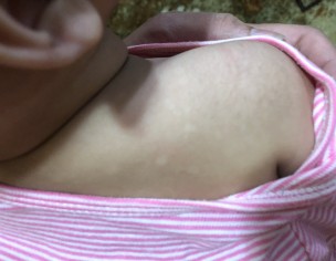 Skin Spots