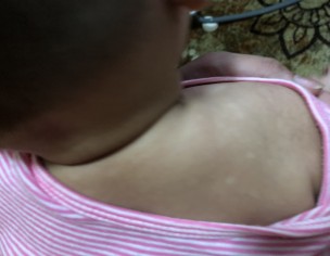 Skin Spots