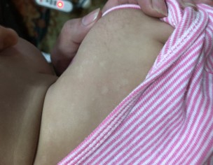 Skin Spots