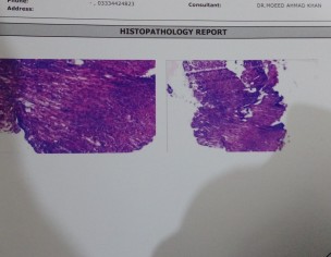 Hiatal Hernia