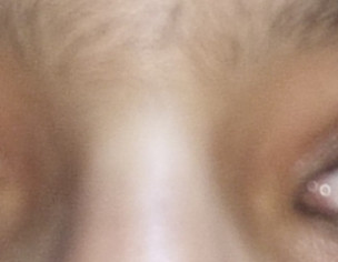 Eye Problem