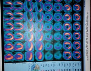 Heart Issue
