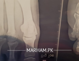 Bone Size Increase.