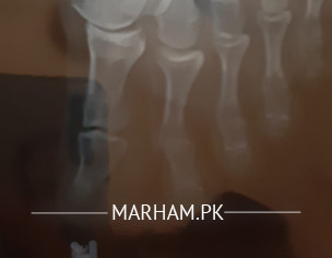 Bone Size Increase.