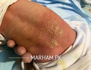 Rashes On Body