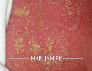 Rashes On Body