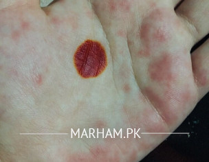 Allergy On Hands