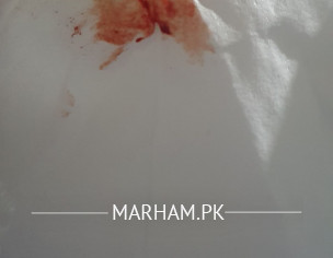 Bleeding From Belly Button