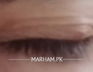 Eye Problem