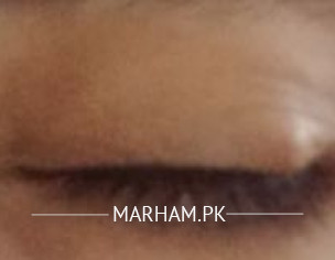 Eye Problem
