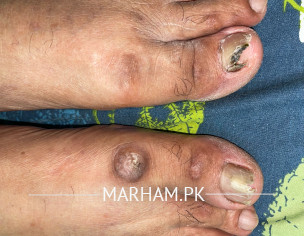 Dystrophic Nail