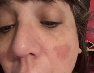 Sores Raw Lumps Inside Cheeks