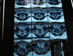 Severe Back Pain 
