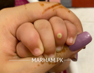 Pustule On Finger
